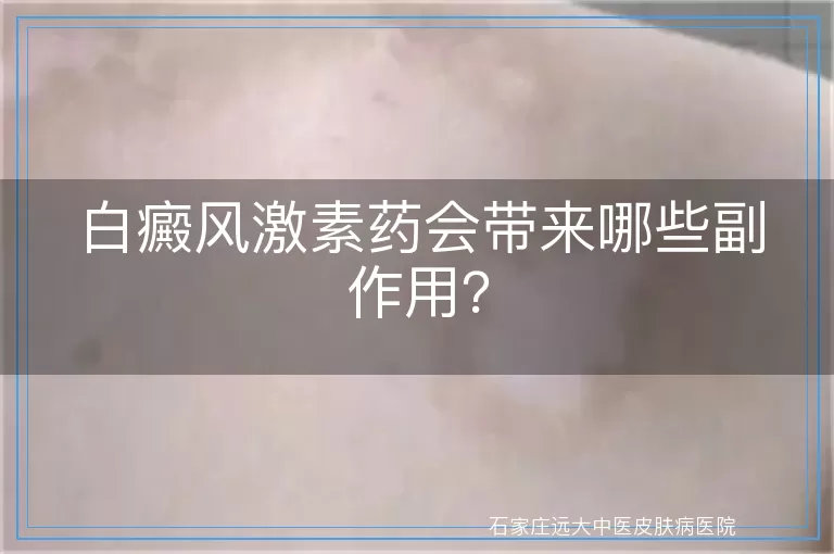 白癜风激素药会带来哪些副作用？