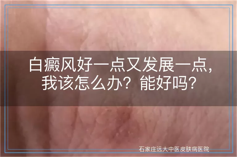 白癜风好一点又发展一点，我该怎么办？能好吗？