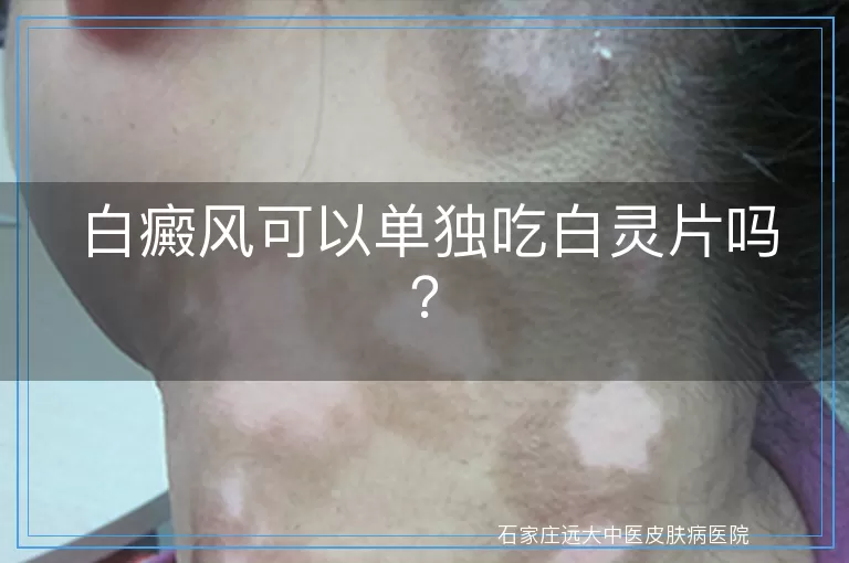 白癜风可以单独吃白灵片吗？