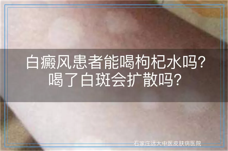 白癜风患者能喝枸杞水吗？喝了白斑会扩散吗？