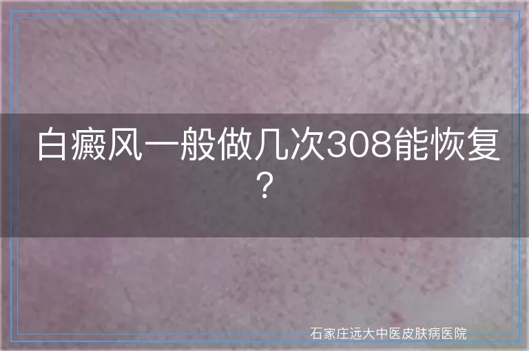 白癜风一般做几次308能恢复？