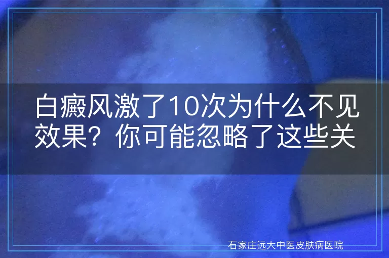 白癜风激了10次为什么不见效果？你可能忽略了这些关键点！