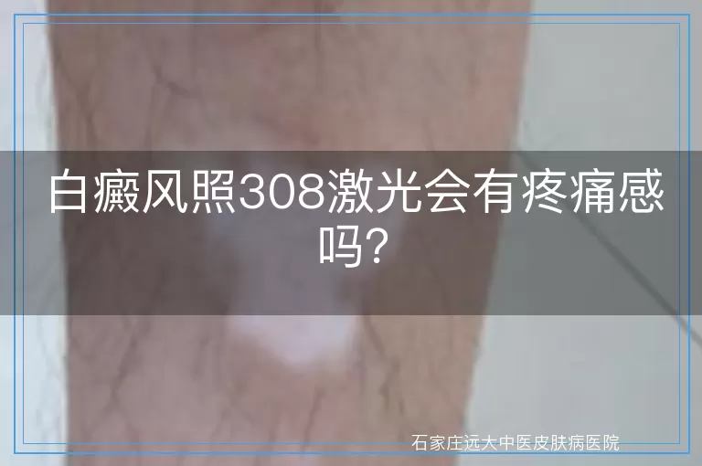 白癜风照308激光会有疼痛感吗？