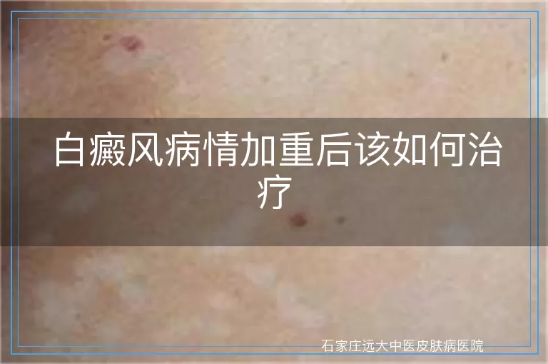 白癜风病情加重后该如何治疗