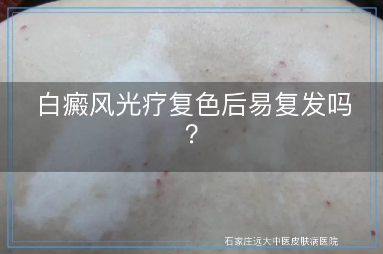 白癜风光疗复色后易复发吗？