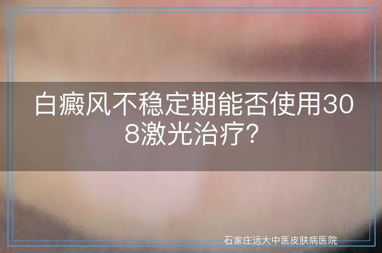 白癜风不稳定期能否使用308激光治疗？