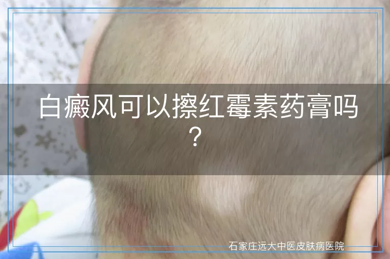 白癜风可以擦红霉素药膏吗？