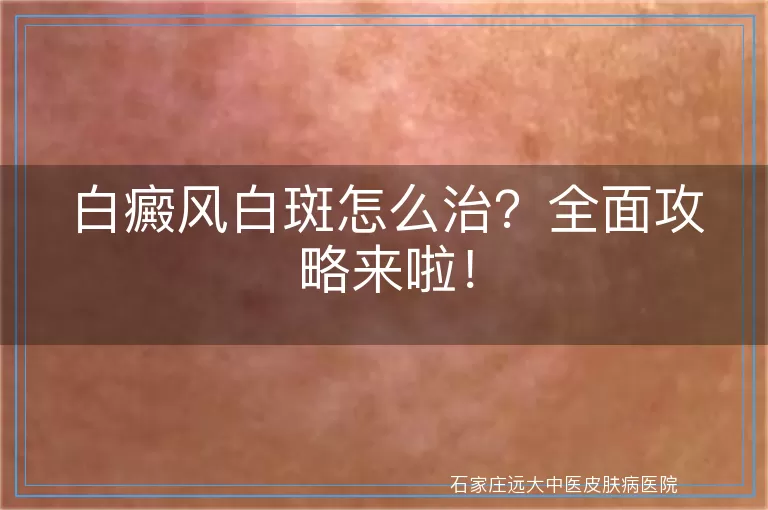 白癜风白斑怎么治？全面攻略来啦！