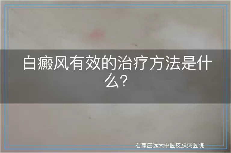 白癜风有效的治疗方法是什么？