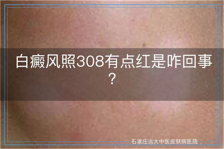 白癜风照308有点红是咋回事？