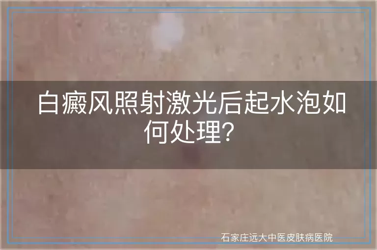 白癜风照射激光后起水泡如何处理？