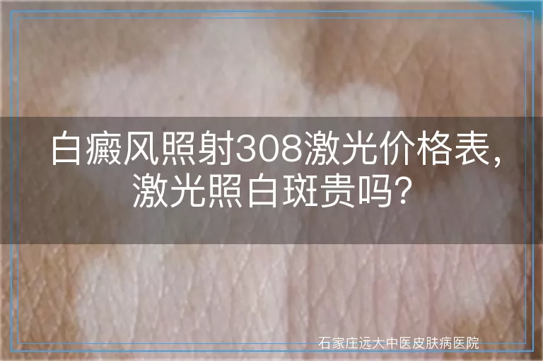 白癜风照射308激光价格表，激光照白斑贵吗？