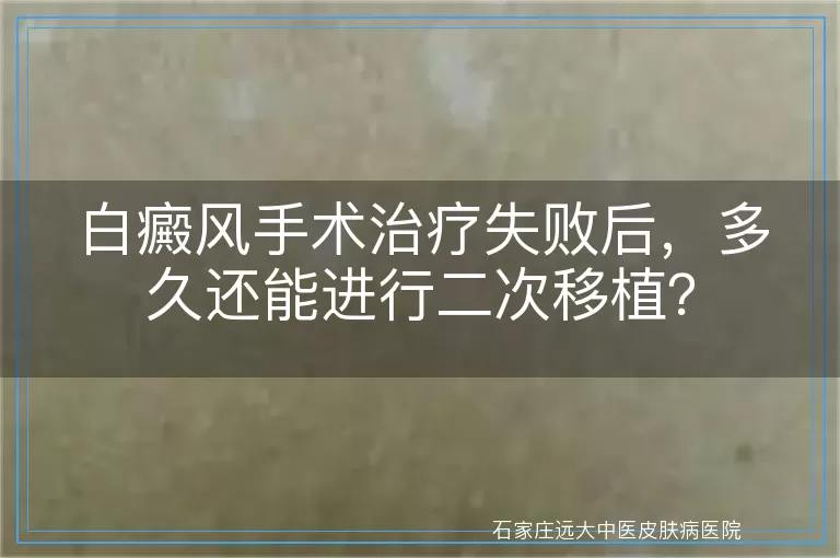 白癜风手术治疗失败后，多久还能进行二次移植？