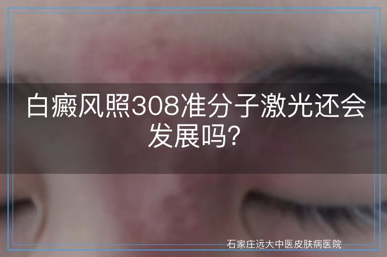 白癜风照308准分子激光还会发展吗？