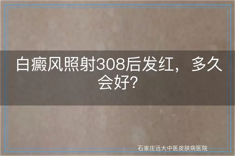 白癜风照射308后发红，多久会好？