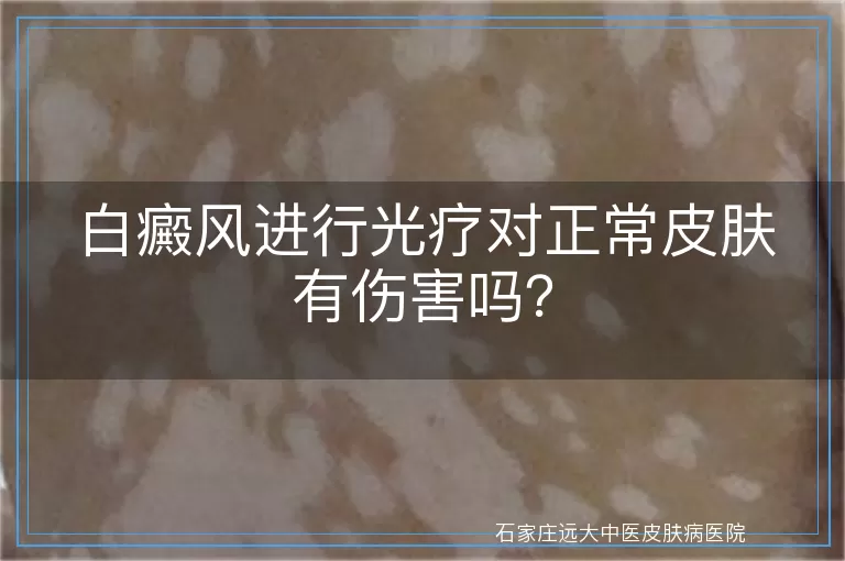 白癜风进行光疗对正常皮肤有伤害吗？