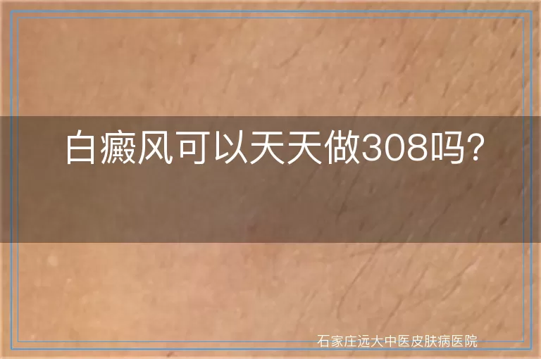 白癜风可以天天做308吗？