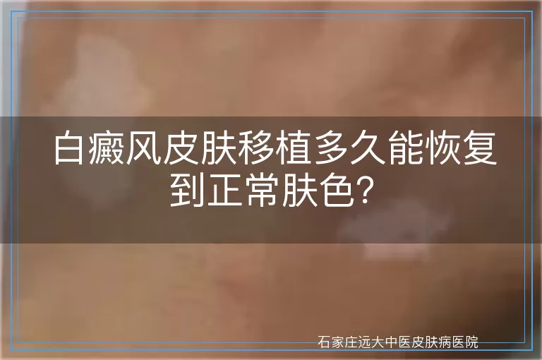 白癜风皮肤移植多久能恢复到正常肤色？