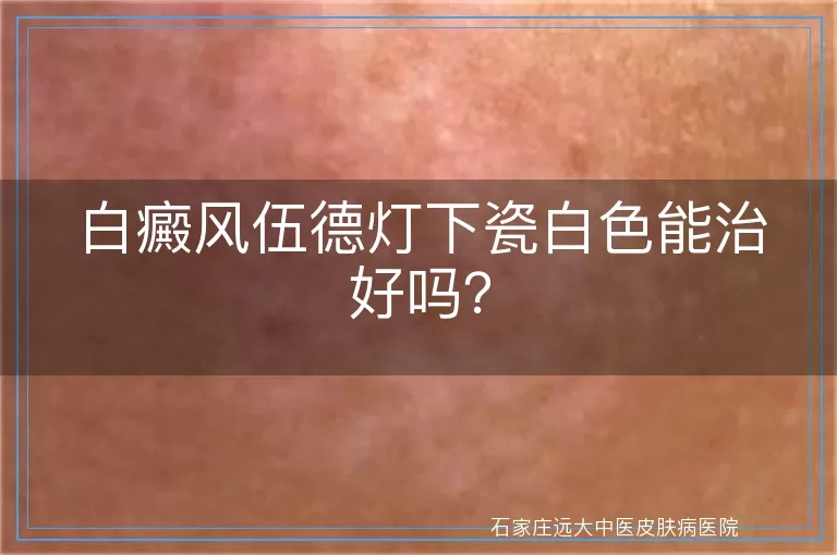 白癜风伍德灯下瓷白色能治好吗？