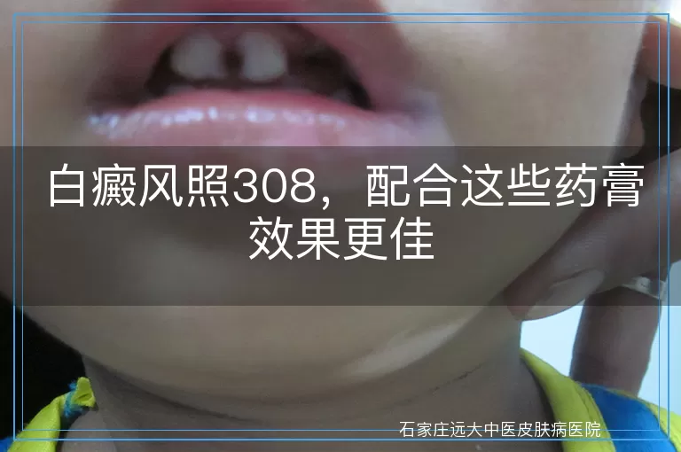 白癜风照308，配合这些药膏效果更佳