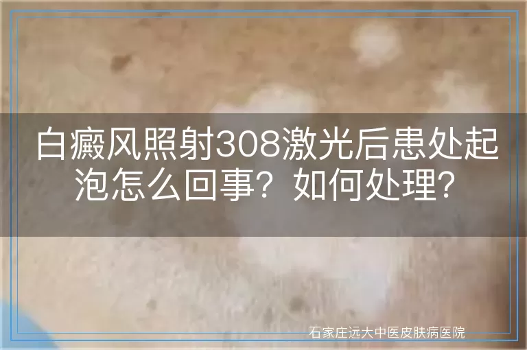 白癜风照射308激光后患处起泡怎么回事？如何处理？