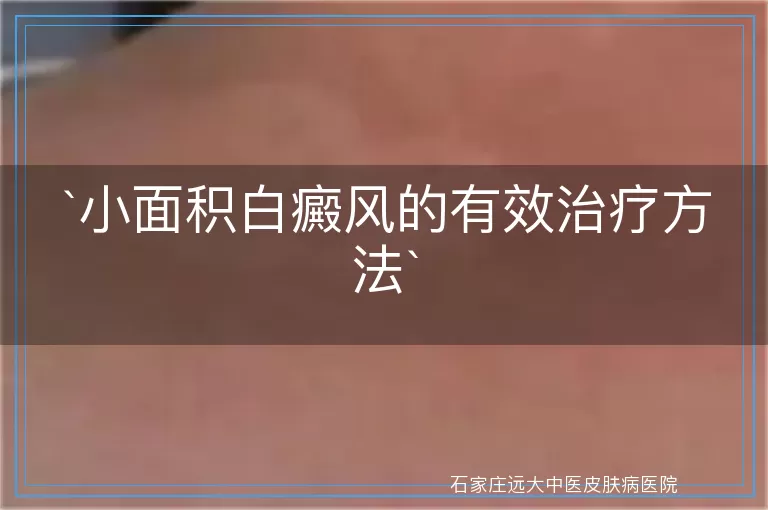 小面积白癜风的有效治疗方法