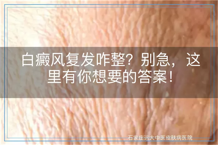 白癜风复发咋整？别急，这里有你想要的答案！