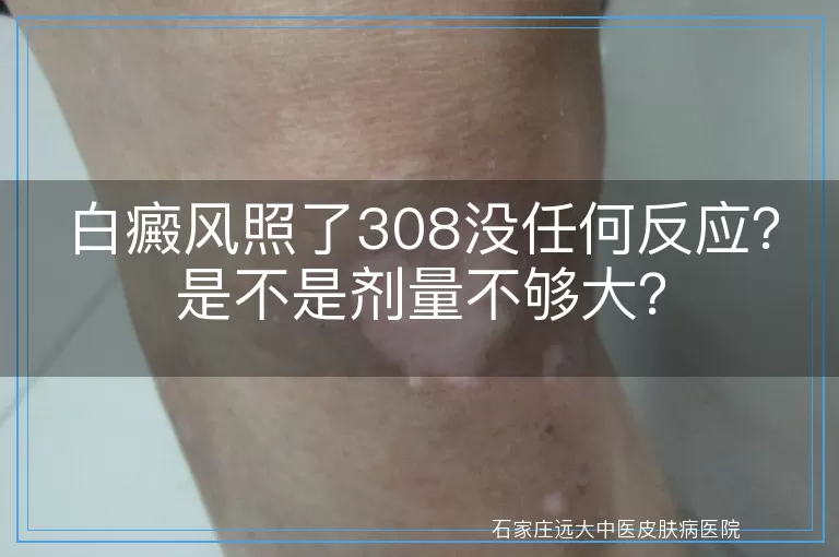 白癜风照了308没任何反应？是不是剂量不够大？