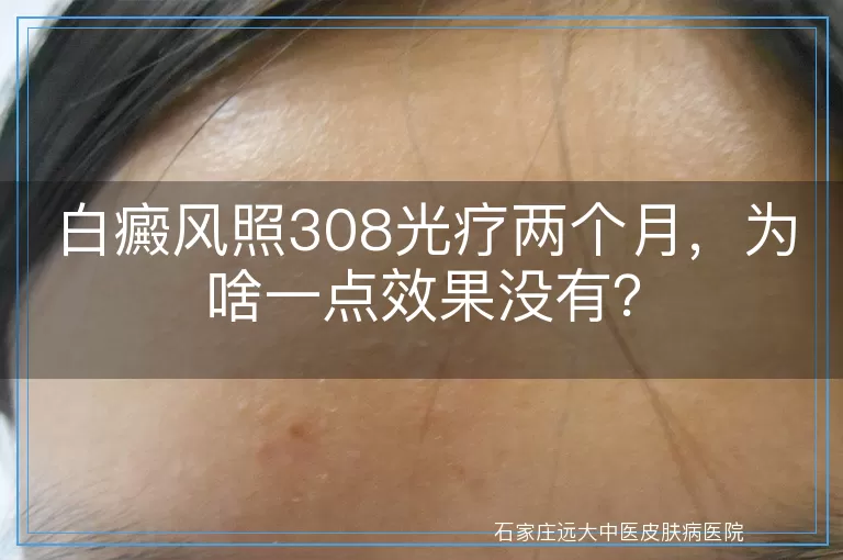 白癜风照308光疗两个月，为啥一点效果没有？