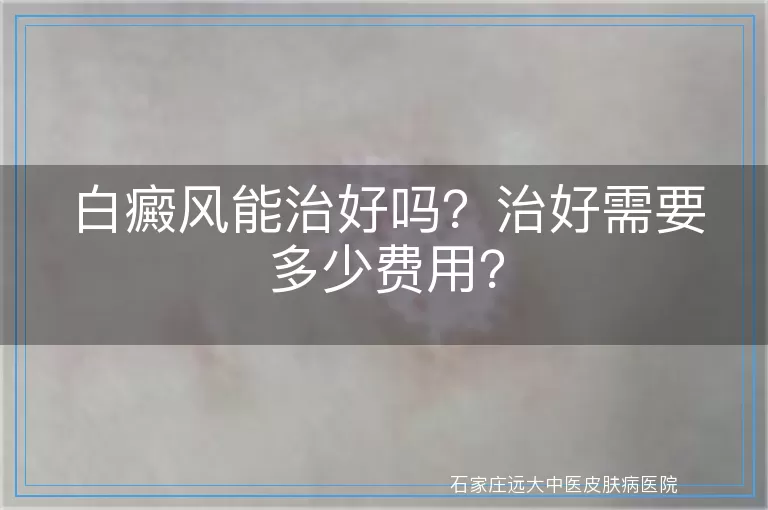 白癜风能治好吗？治好需要多少费用？