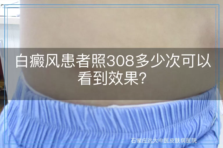 白癜风患者照308多少次可以看到效果？