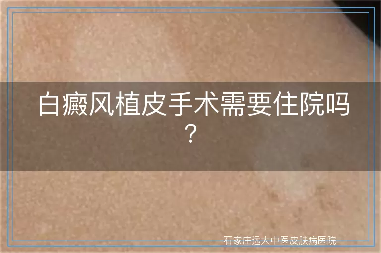 白癜风植皮手术需要住院吗？