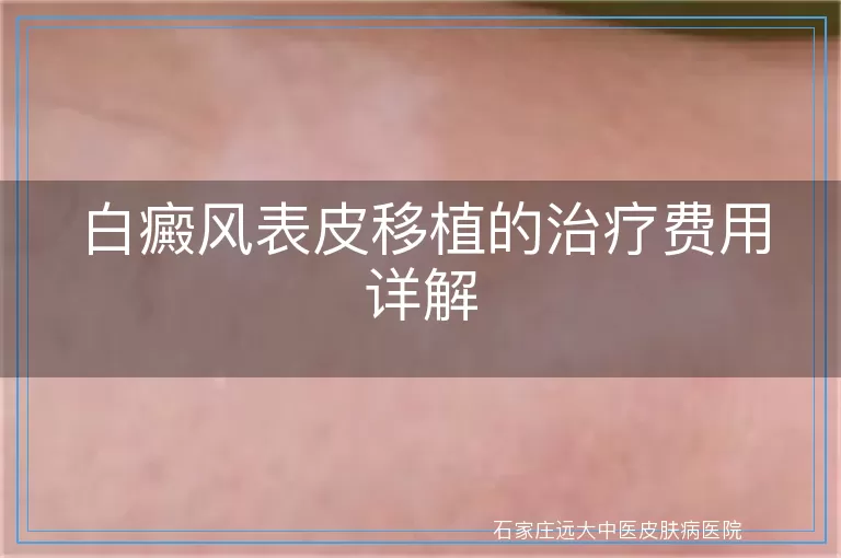 白癜风表皮移植的治疗费用详解