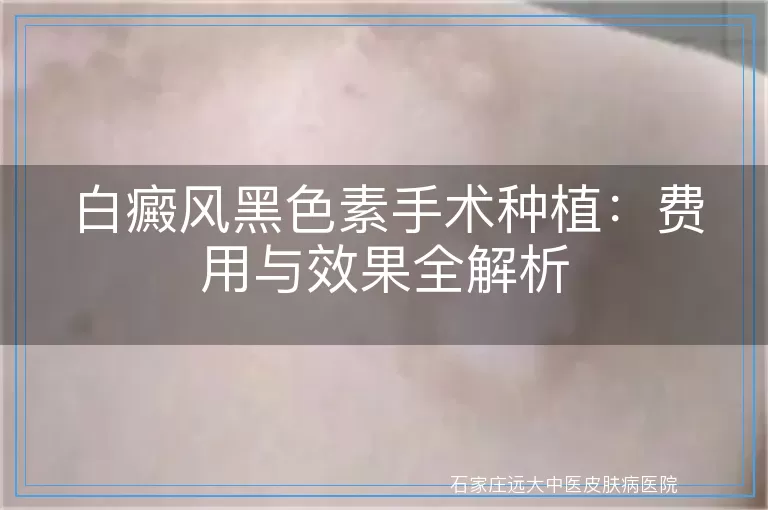 白癜风黑色素手术种植：费用与效果全解析