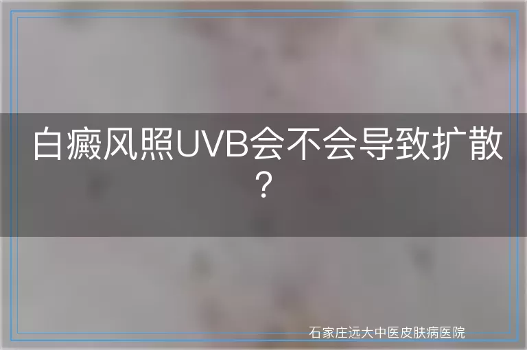 白癜风照UVB会不会导致扩散？