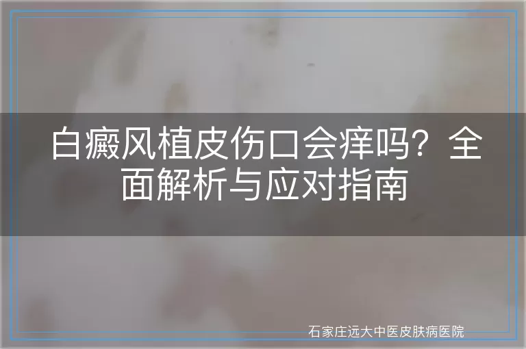 白癜风植皮伤口会痒吗？全面解析与应对指南