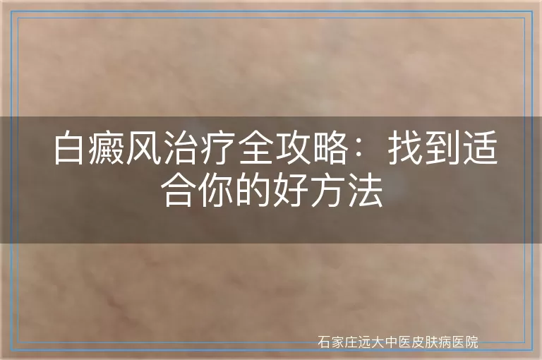 白癜风治疗全攻略：找到适合你的好方法