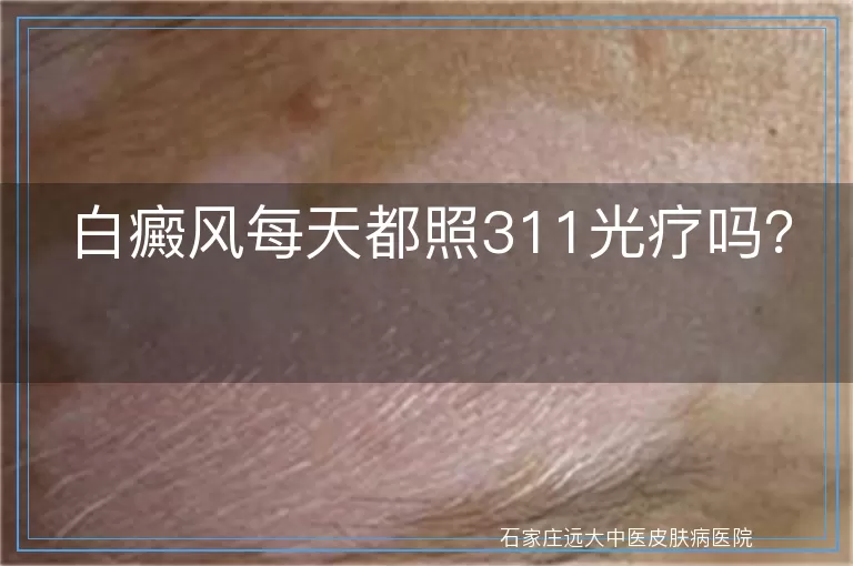 白癜风每天都照311光疗吗？