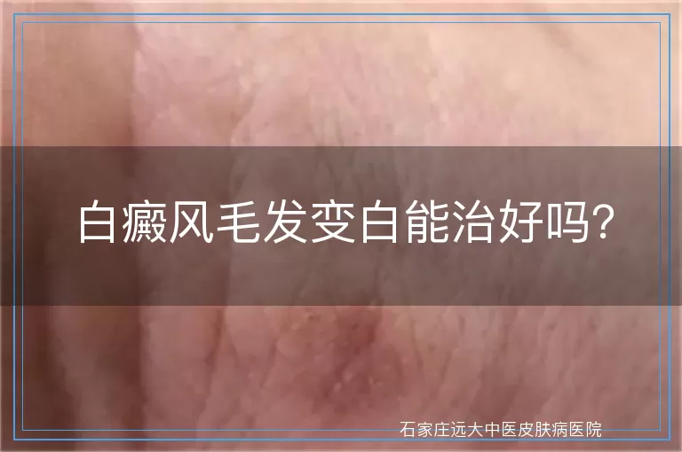 白癜风毛发变白能治好吗？