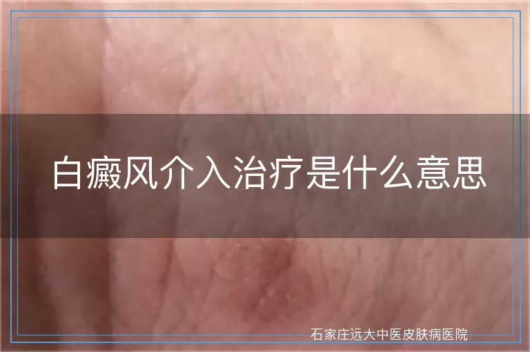 白癜风介入治疗是什么意思